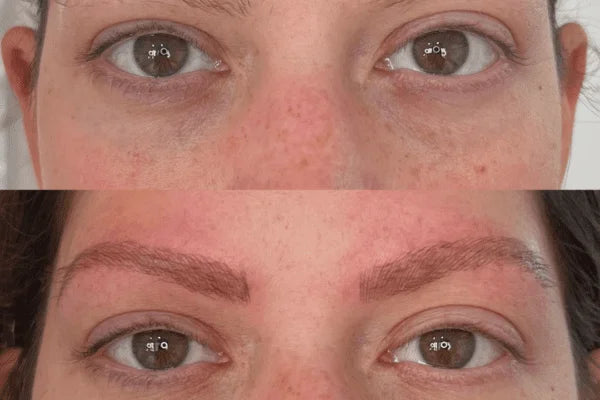 Hair Growth & Beard Needling Roller - 2-Piece Derma Roller